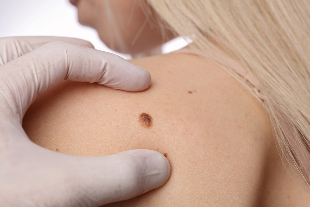 Dermatologist in Kerrville TX performing seborrheic keratosis exam