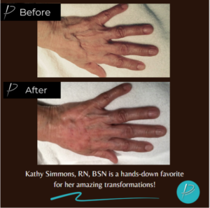 Radiesse Before and After