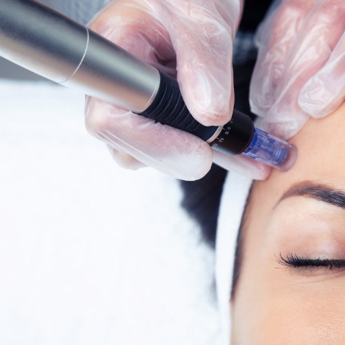 microneedling for acne and acne scars