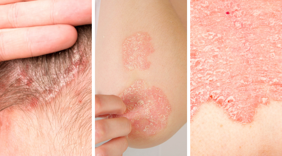 psoriasis treatment in kerrville, tx
