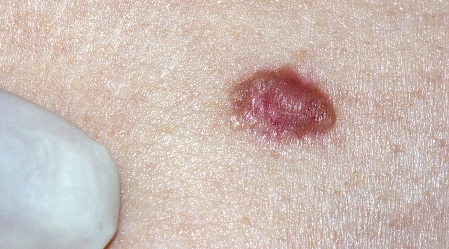 Basal Cell Carcinoma Treatment in Kerrville, TX
